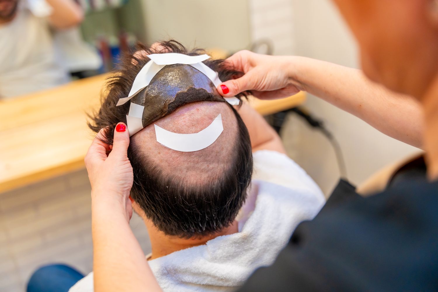 man getting a hair transplant
